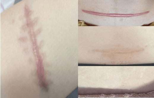 20260311【孕产印记·无痕守护 ▏剖宫产疤痕无痕化科普③】破除误区 · 从“知”开始413