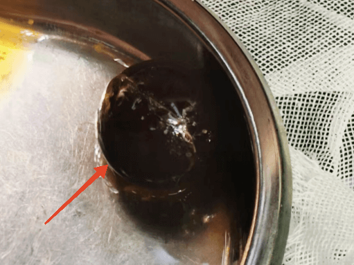 1龄童误食“水宝宝” 儿外科急救保安全351